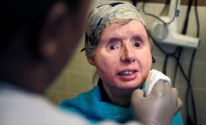 Woman with DoD-funded face transplant suffers complications