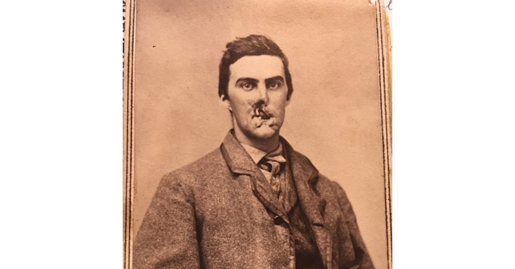 With a face disfigured by war, this Union soldier’s life remained a near constant struggle