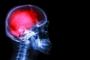 Some traumatic brain injuries linked to increased risk of brain cancer