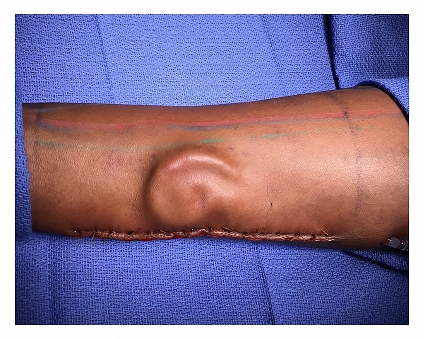 Soldier gets new ear after growing it on her arm