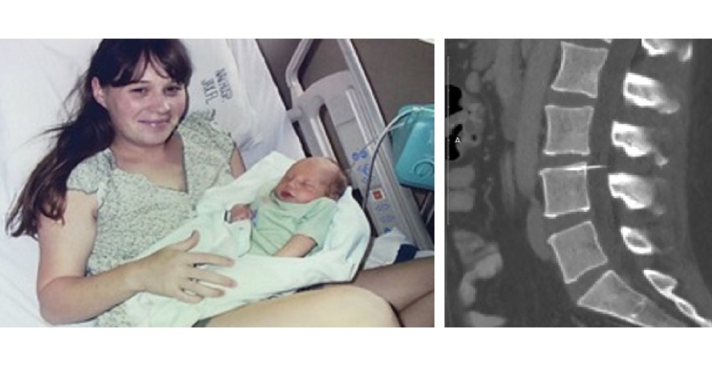 Navy wife alleges malpractice after doctors find broken needle ― from 2003 ― in her spine